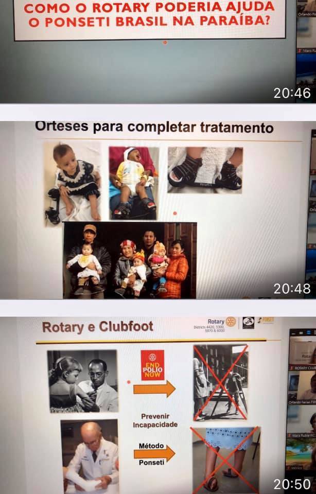 método Ponseti - Pé torto congênito - tratamento