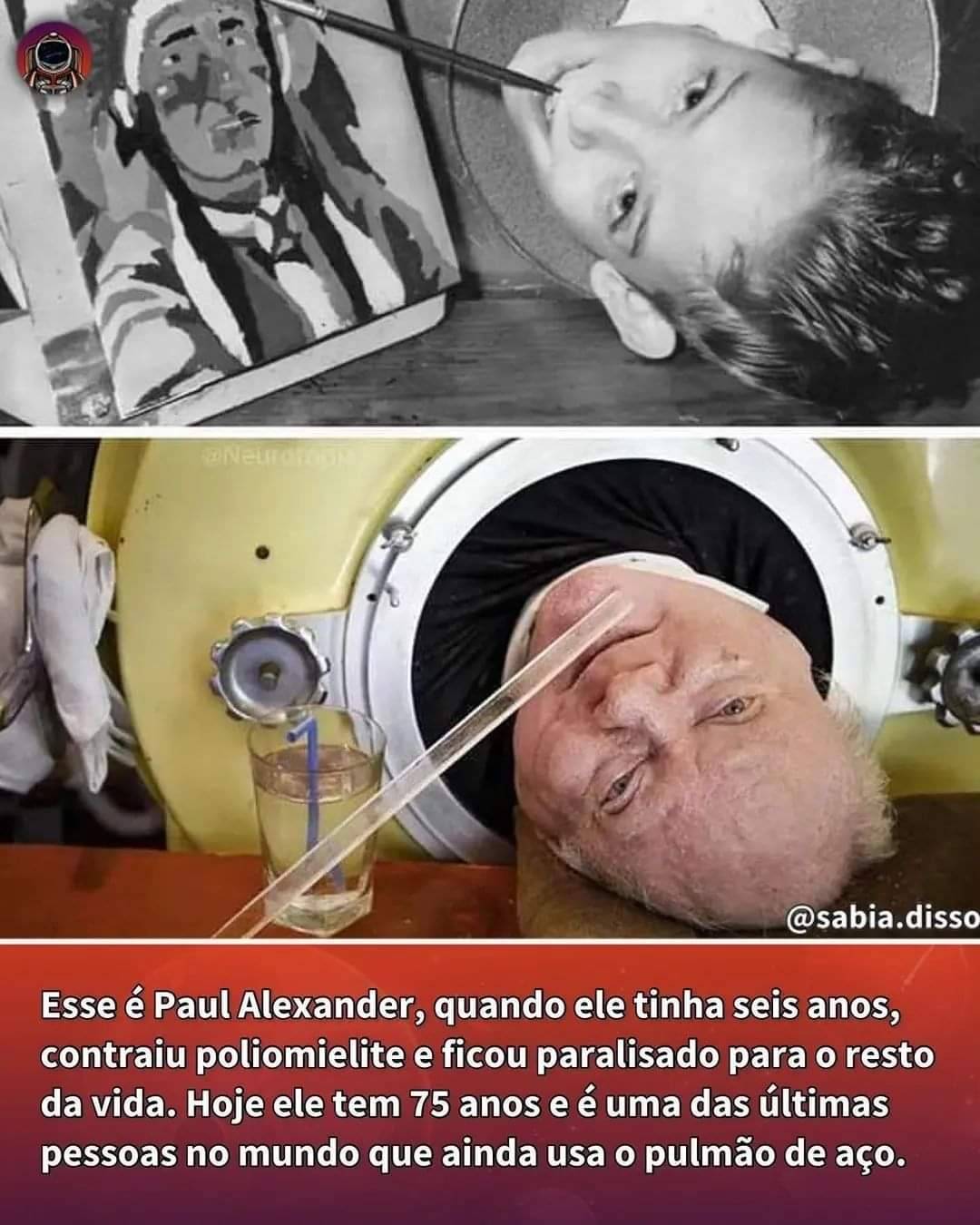 Pulmão de Aço - Pesadelo do passado que, se não erradicarmos a poliomielite, pode voltar a ser realidade