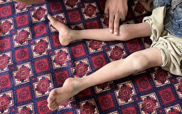 A Importância da Vacinação Contra a Poliomielite